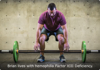 Brian, who lives with Factor XIII deficiency Brian, who lives with Factor 13 deficiency, is preparing to lift a barbell with weights